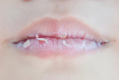 Awas! Ini Penyebab Bibir Pecah-Pecah?