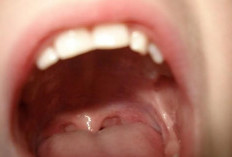 Kondisi Mulut Terkait 4 Penyakit