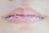 Awas! Ini Penyebab Bibir Pecah-Pecah?